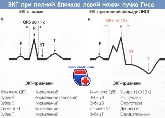 Блокада левой ножки пучка гиса на экг. ЭКГ при блокаде левой ножки пучка Гиса. Полная блокада левой ножки пучка Гиса на ЭКГ признаки. ЭКГ полная блокада левой ножки пучка Гиса ЭКГ.