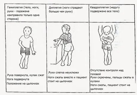 Двойная гемиплегия