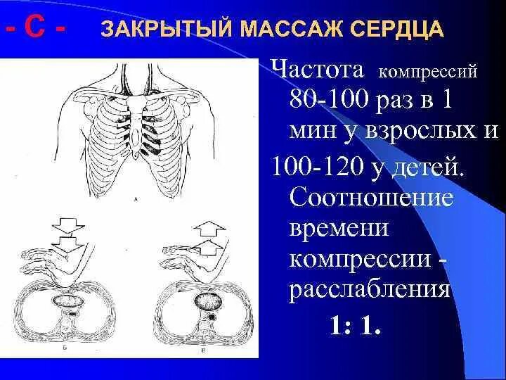 Частота закрытого массажа сердца. Закрытый массаж сердца. Закрытом массаже сердца. Соотношение компрессий расслабление 1:1 это.