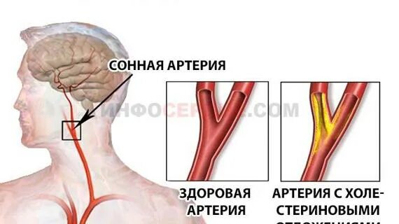 Стеноз внутренней сонной артерии. Стеноз сонной артерии симптомы. Симптомный стеноз сонных артерий. Сужение шейных сосудов