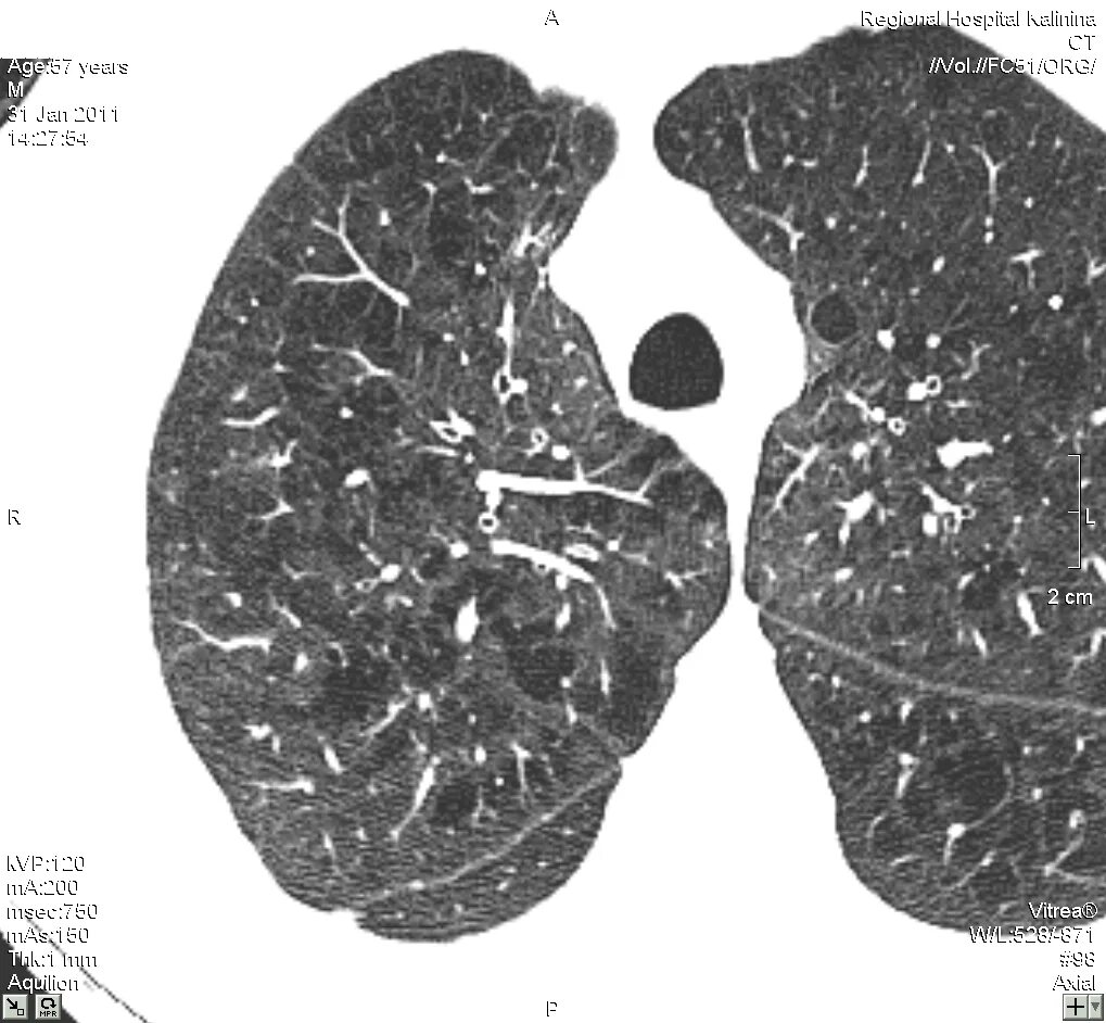 Центрилобулярная эмфизема легких на кт. Центрилобулярная эмфизема на кт. Буллезная эмфизема легких кт. Центрилобулярная эмфизема на кт. Центрилобулярная эмфизема.