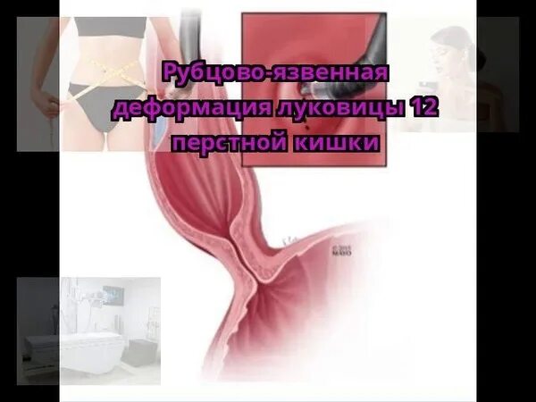 Рубцовая деформация луковицы двенадцатиперстной. Луковица 12 перстной кишки деформирована. рубцово язвенная деформация луковицы. рубцово-язвенная деформация дпк. рубцовая деформация луковицы 12 перстной кишки.