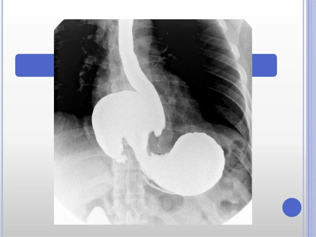 Скопия пищевода. Диафрагмальная грыжа желудка рентген. Грыжа пищеводного отверстия диафрагмы рентген. Грыжа пищевого отверстия диафрагмы рентген. Контрастирование желудка рентген.