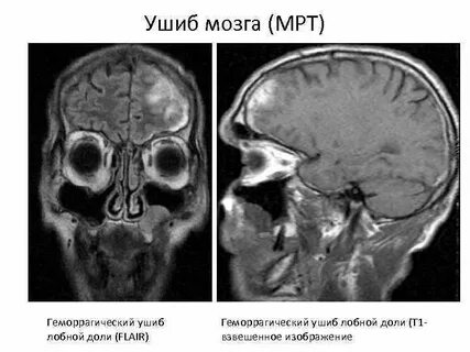 Мрт лобных долей мозга