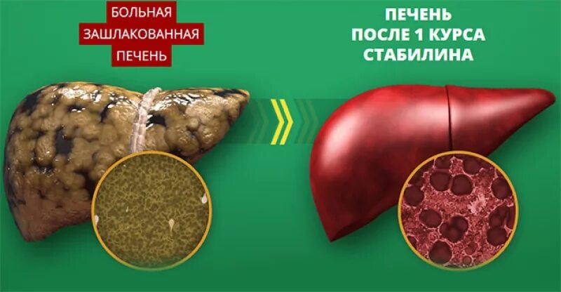 Сколько времени восстанавливается печень после. Печень здоровая и больная.