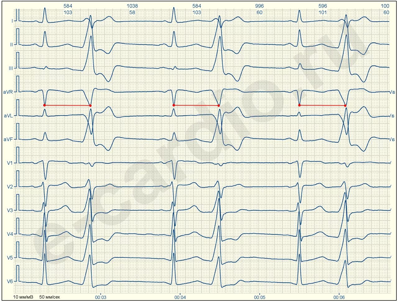 ЭКГ монотопные желудочковые экстрасистолы. Наджелудочковая экстрасистолия бигеминия ЭКГ. Наджелудочковая экстрасистола на ЭКГ. Желудочковая экстрасистолия на ЭКГ. Политопные экстрасистолы