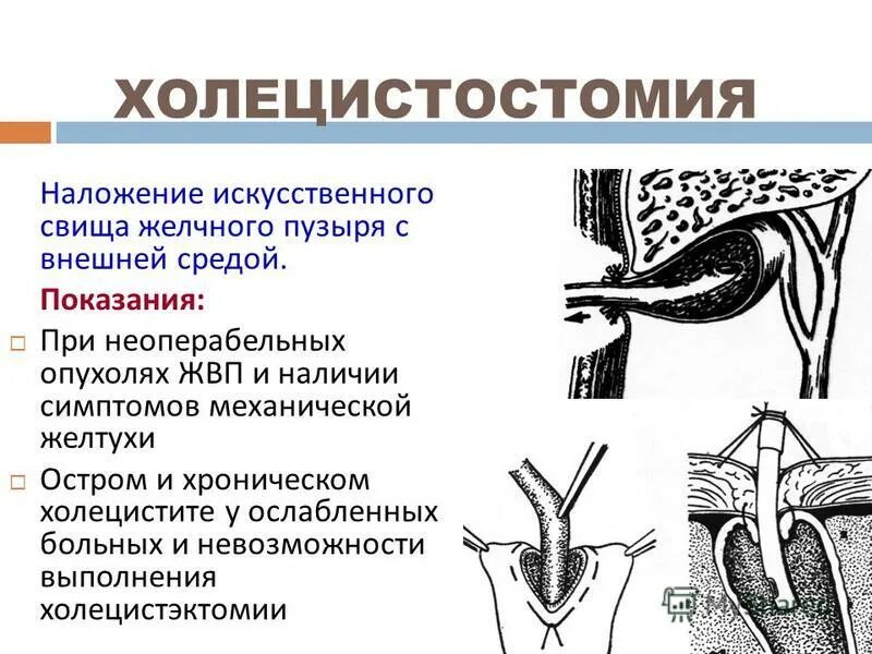 Дренирование желчного пузыря. Дренирование желчного пузыря