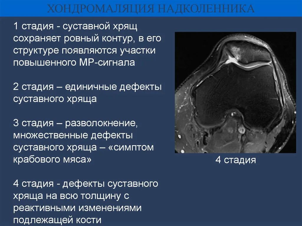 Хондромаляция мыщелков. Хондромаляция суставного хряща надколенника 2 степени. Степени хондромаляции надколенника. Хондромаляция мыщелка бедренной кости 4. Хондромаляция хряща мрт.