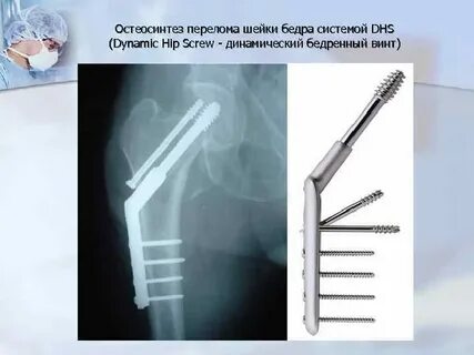 Остеосинтез винтами