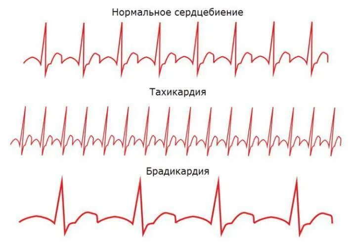 Учащение или замедление пульса. Тахикардия и брадикардия. синусовая тахикардия и брадикардия. пульс тахикардия брадикардия. тахикардия - это учащение пульса:.