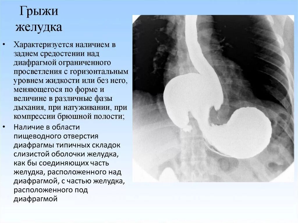 Диафрагмальный пищевода