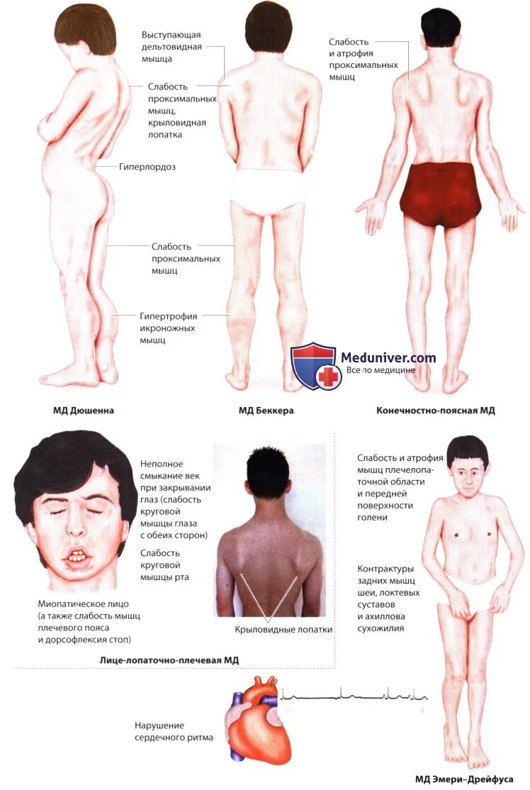 Признаки миопатии