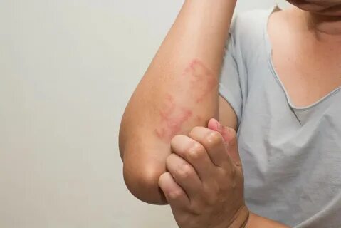 Как проявляется аллергия на кофе у взрослых, основные симптомы 