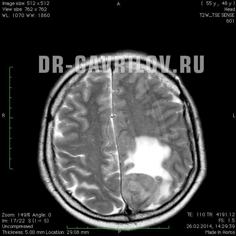 Менингиома твердой мозговой оболочки. После операции менингиомы головного мозга