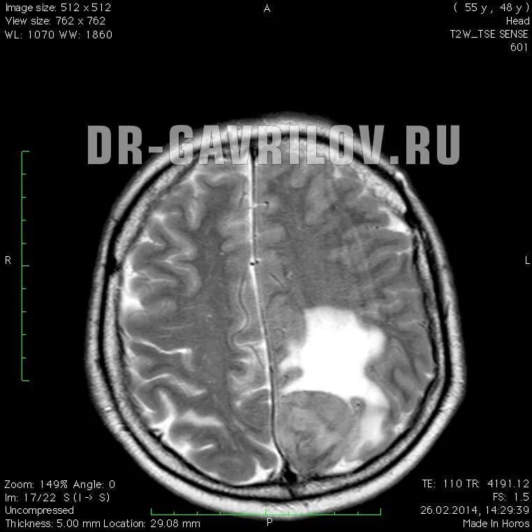 Объемное образование головного мозга код. Менингиома твердой мозговой оболочки.