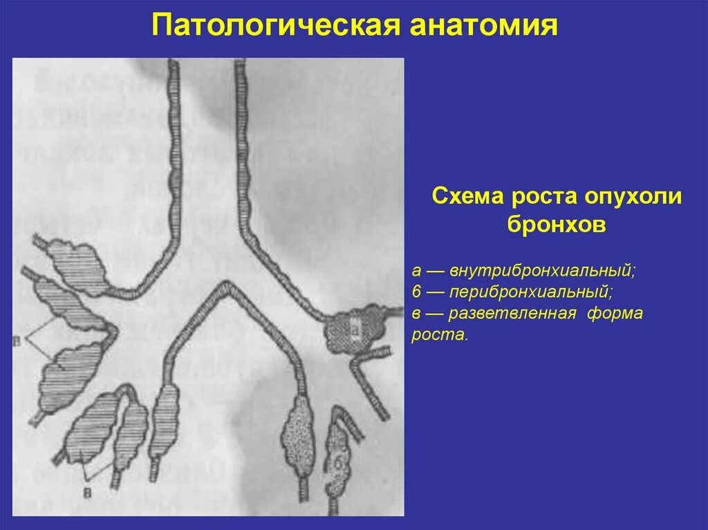 Стадии рака бронха. Опухоль легкого патанатомия. Патоморфология бронхов. Опухоли легких классификация патанатомия.