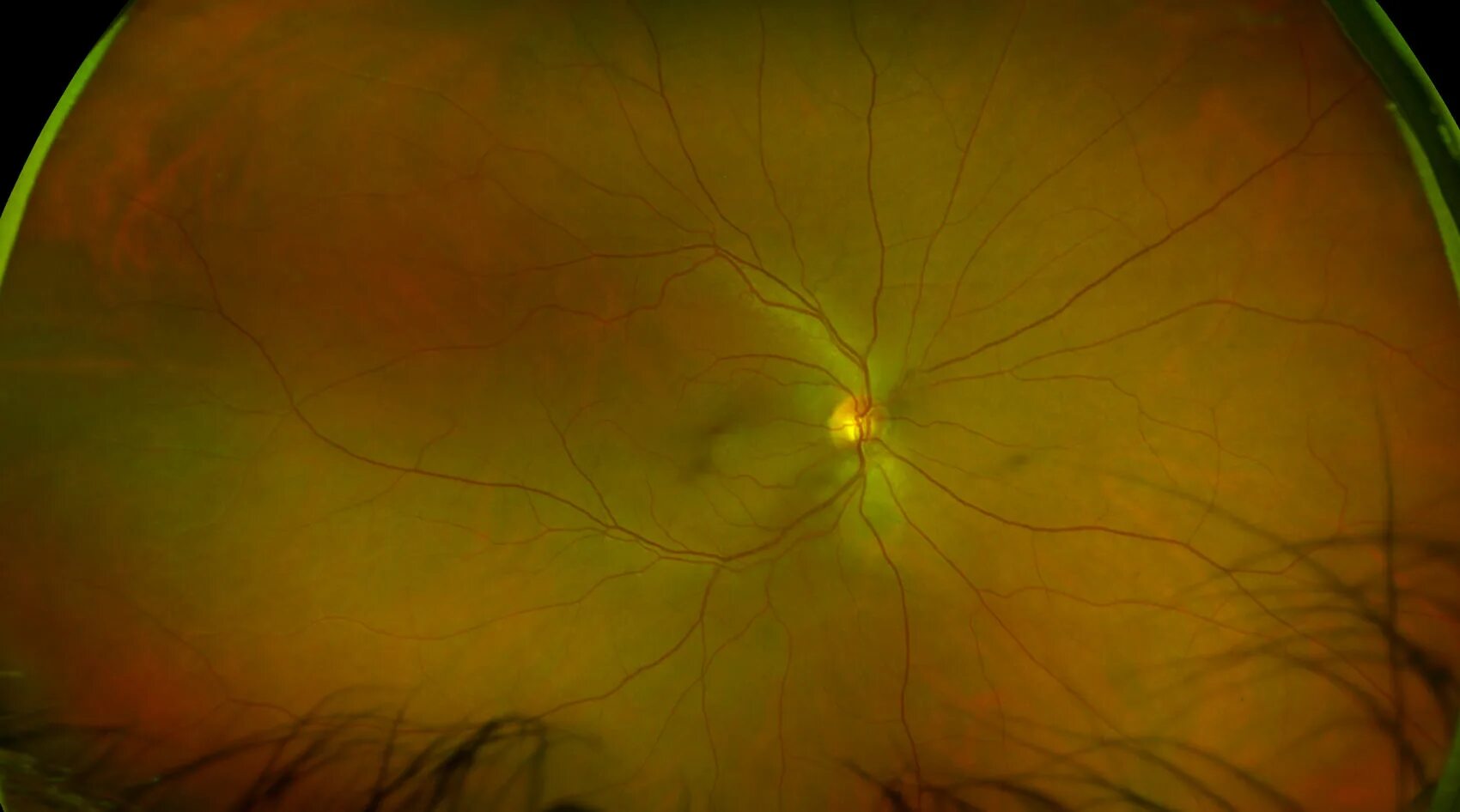 Прима макула. Центральная серозная ретинопатия. Рубек макулы. Вальсальва ретинопатия.