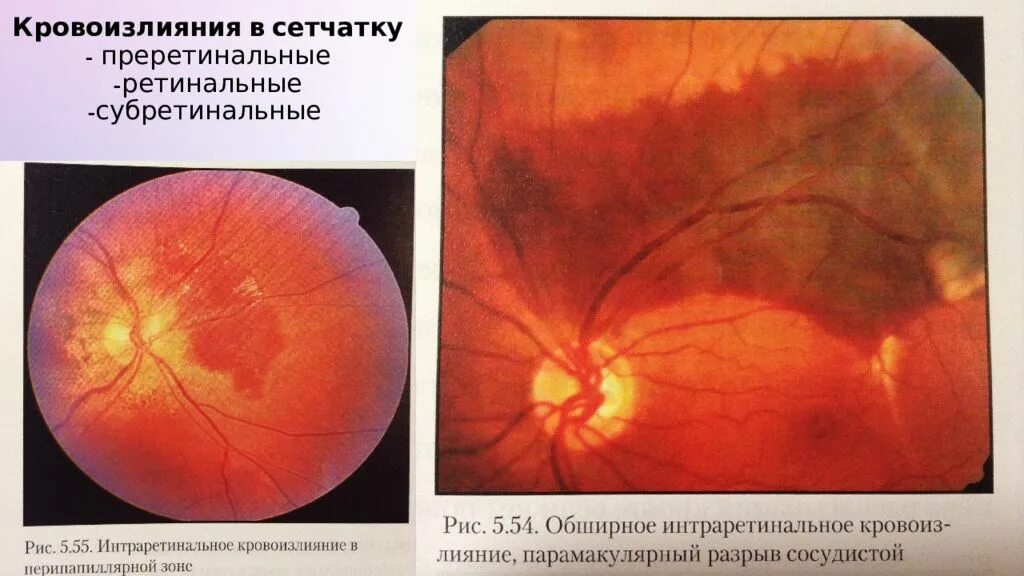 Преретинальное кровоизлияние сетчатки. Субретинальный разрыв сосудистой оболочки. Кровоизлияние сосудистой оболочки глаза.