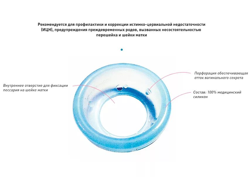 Как удлинить шейку при беременности. Акушерский пессарий доктор Арабин. Кольцо для шейки матки при беременности. Постановка акушерского пессария. Постановка кольца на шейку матки при беременности.