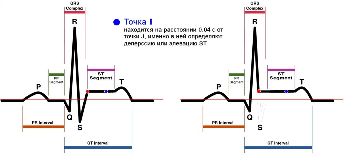 Изменение комплекса qrs
