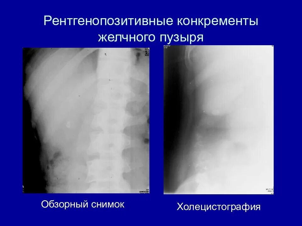 Пероральная холецистография. Холецистография желчного пузыря. Конкременты желчного пузыря рентген. Камни желчного пузыря рентген.