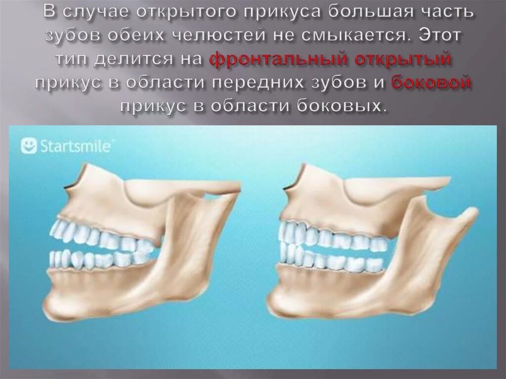 Зубы при закрытом рте. Прикус открытый передний и открытый боковой. Открытый боковой прикус односторонний. Открытый боковой прикус двусторонний.