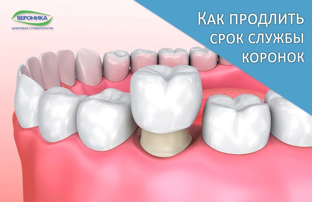 Коронка металлокерамика. Металлокерамика коронки срок службы. Срок службы металлокерамической коронки и керамической коронки. Срок службы керамических