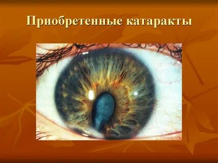 Симптомы катаракты после 60