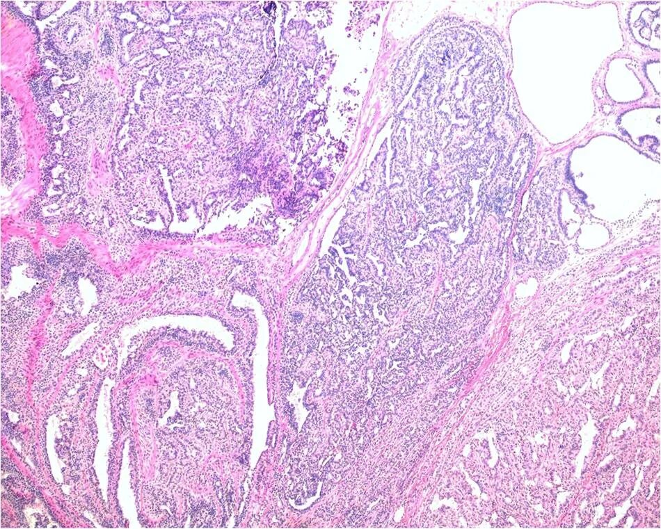 стадии светлоклеточного рака