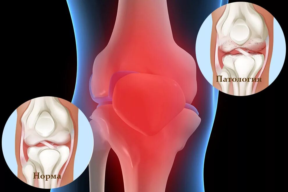 Болит ли мениск. Менископатия коленного сустава. Разрыв мениска коленного сустава и киста. Воспаление сустава мениск. Разрыв мениска коленного сустава симптомы.