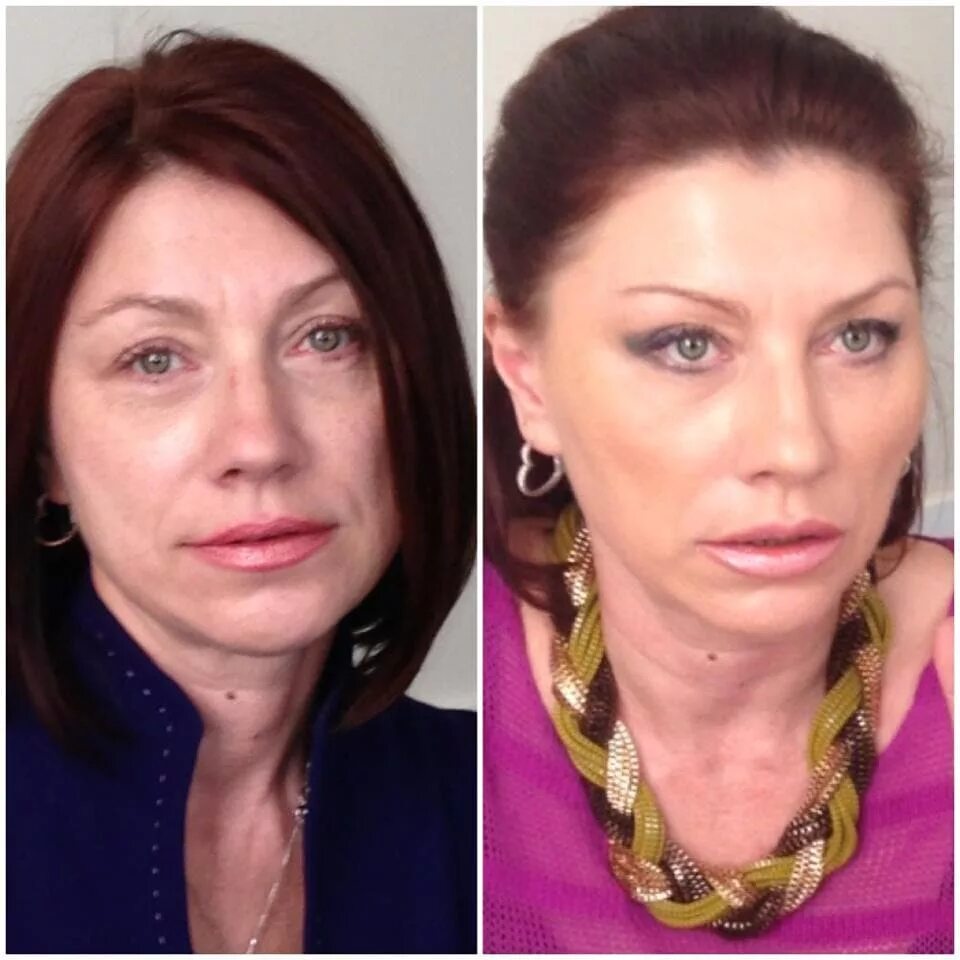 Филлеры для лица и алкоголь до и после. Моделирование лица до и после. Лариса гузеева блефаропластика. Что нельзя делать после филлеров в лицо. Ботокс в скулы.