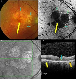 Age related macular degeneration