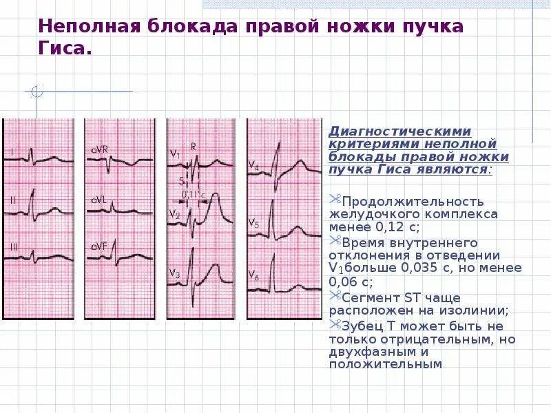 Блокада ПНПГ на ЭКГ. Блокада левой ножки пучка Гиса. Блокада левой ножки пучка Гиса на ЭКГ. Блокада правой ножки пучка Гиса и левой ножки на ЭКГ. Левая ножка п гиса