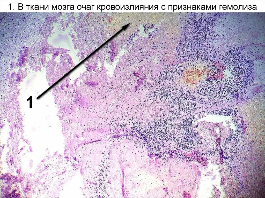 Микропрепарат головного мозга. Ишемический инфаркт мозга микропрепарат. Гематома мозга микропрепарат. Диапедезные кровоизлияния в головной мозг препарат. Гематома головного мозга микропрепарат.