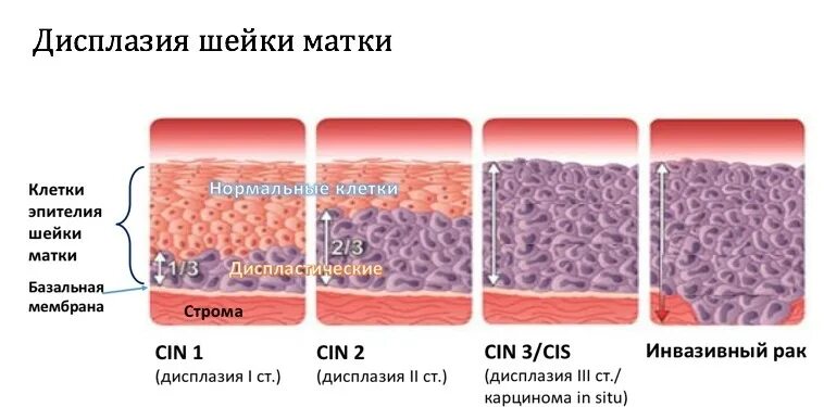 Интраэпителиальное поражение hsil. Дисплазия 2 плоского эпителия. Прижигание дисплазии шейки матки 1 степени. Дисплазия шейки матки Cin 1-2. Методы диагностики дисплазии эпителия шейки матки.