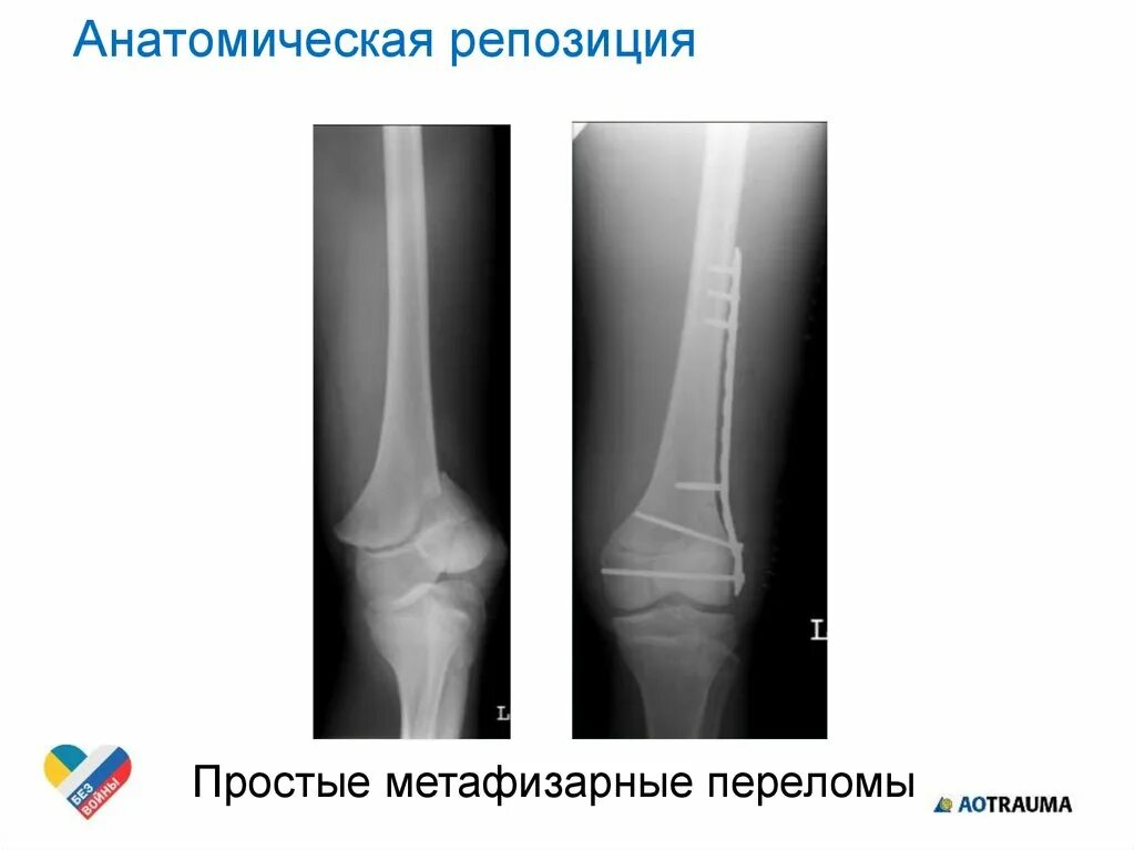 Диски wci mt10. Диски пежо без центрального отверстия. Репозиция отломков при закрытом переломе. Диск пежо 406 без центрального отверстия. Репозиция при переломе костей предплечья.
