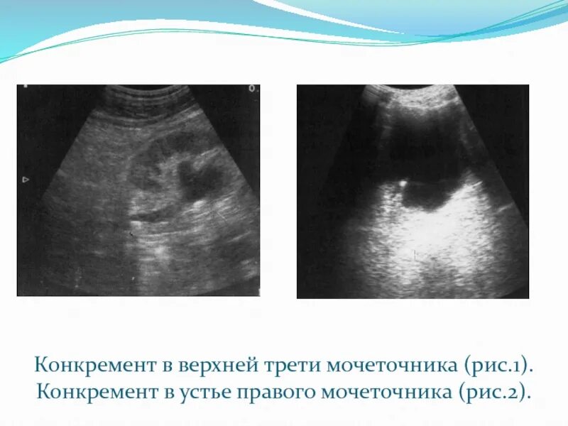 Анализ мочеточника. Конкремент в Устье мочеточника УЗИ. Камень устья мочеточника на УЗИ. Устье левого мочеточника на УЗИ. Проксимальный отдел мочеточника на УЗИ.