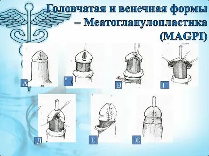 Открытая половая головка