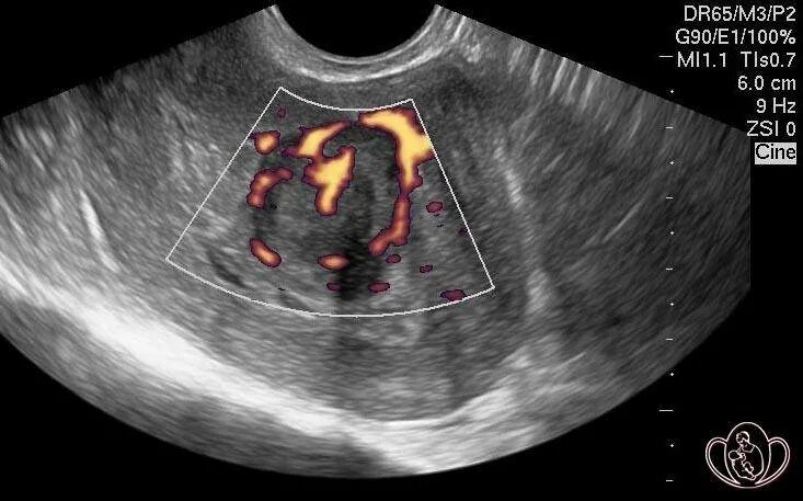 Матка увеличена до 6 недель. Шеечная миома матки УЗИ. Субмукозная миома матки УЗИ. Субмукозный миоматозный узел УЗИ.