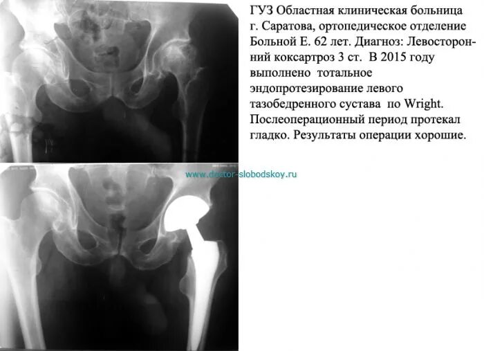 Срок восстановления после замены тазобедренного сустава. Тотальное эндопротезирование тазобедренного сустава по Wright. Протокол эндопротезирования тазобедренного сустава. Коксартроз тазобедренного сустава операция. Коксартроз эндопротезирование тазобедренного сустава.