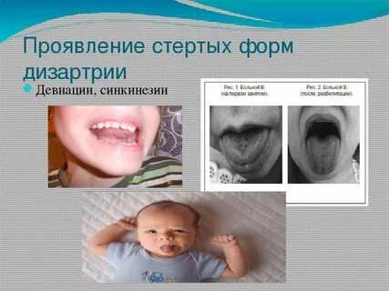 Дизартрия пример