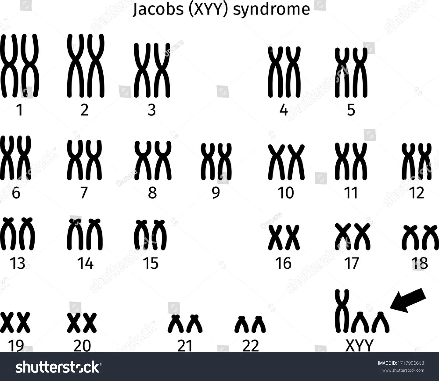 Хромосомы краба. 47 XYY кариотип. Синдром дисомии по у хромосоме кариотип. Klinefelter Syndrome karyotype. Дисомия по х хромосоме у мужчин кариотип.