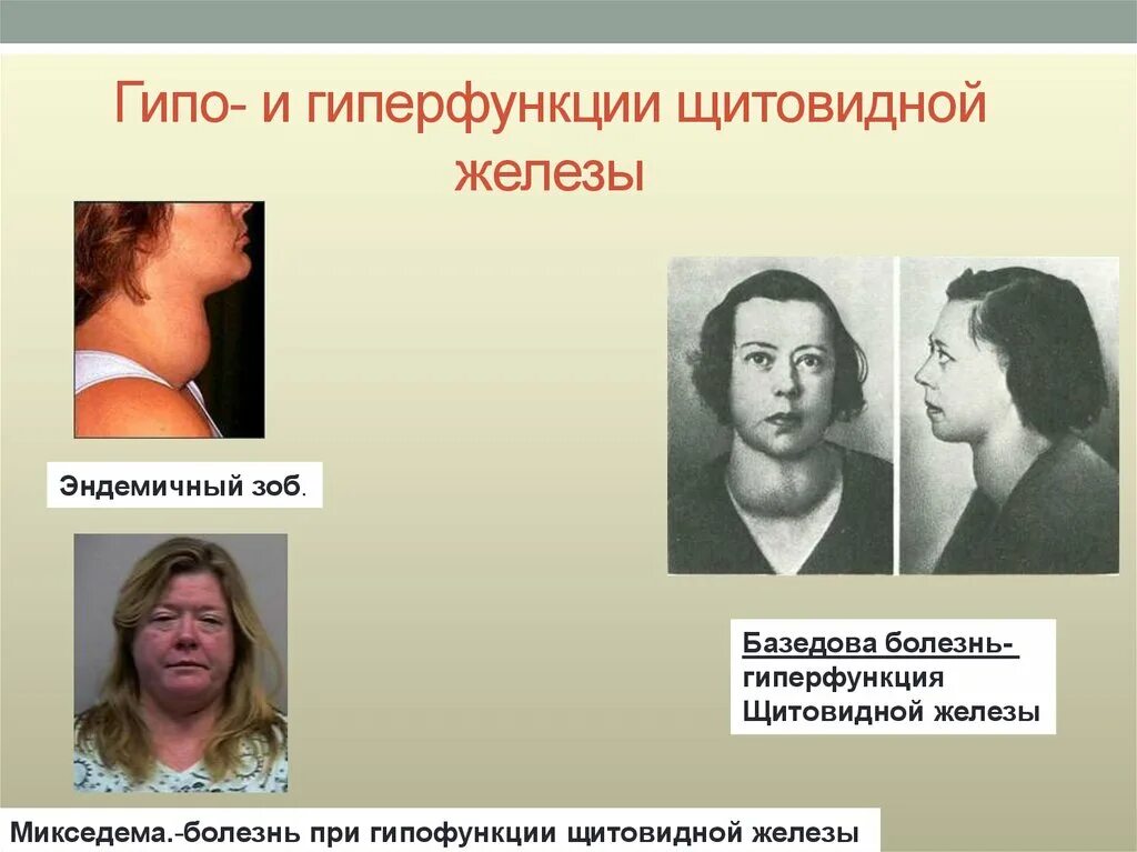 Гиперфункции желез. Щитовидная железа гипофункция и гиперфункция. гиперфункция щитовидной железы, базедова болезнь. заболевания щитовидной железы при гипофункции и гиперфункции.