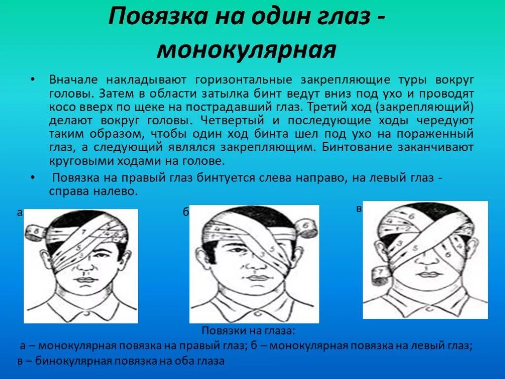 Наложение монокулярной повязки алгоритм. Наложение бинокулярной повязки на глаз алгоритм. Десмургия бинокулярная повязка. Алгоритм наложения повязки на галдз.