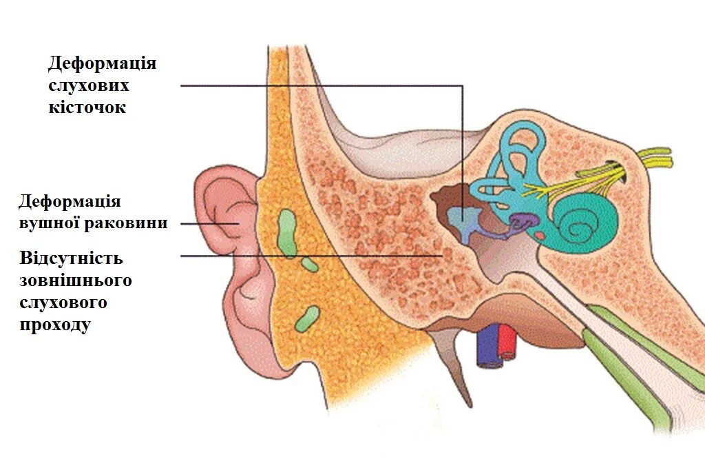 Глубокая ушная раковина. Двусторонняя микротия ушных раковин и атрезия слуховых проходов. Аномалии развития среднего уха. Микротия атрезия слухового прохода. Агенезия (аплазия) наружного слухового прохода.