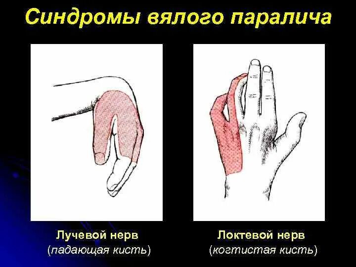 Повреждение локтевого нерва. Синдром при поражении локтевого нерва. Поражение локтевого нерва когтистая кисть. Поражение лучевого нерва неврология. Неврит локтевого нерва когтистая лапа.