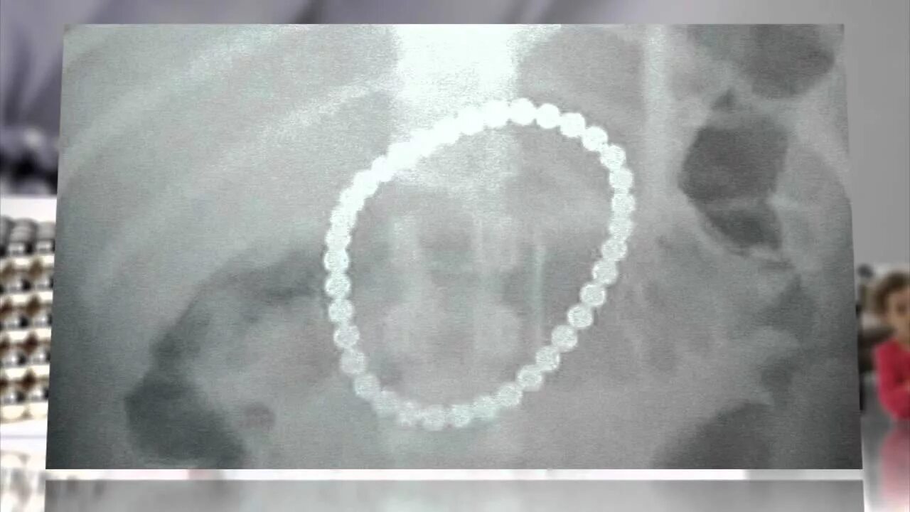 Проглотила шарик. Магнитные шарики на рентгене. Ребенок проглотил магнитные шарики. Проглатывание магнитных шариков. Проглотила шарик.