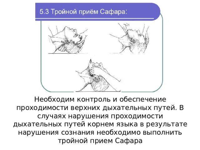 Тройной прием алгоритм. Сафара, для обеспечения проходимости дыхательных путей. Тройной прием Сафара алгоритм. Тройной прием Сафарова.