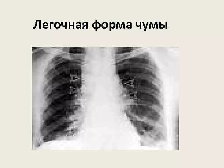 Бубонная чума легочная форма. Чума первично легочная форма. Вторично легочная форма чумы. Легочная форма туляремии. Первично легочная форма чумы.