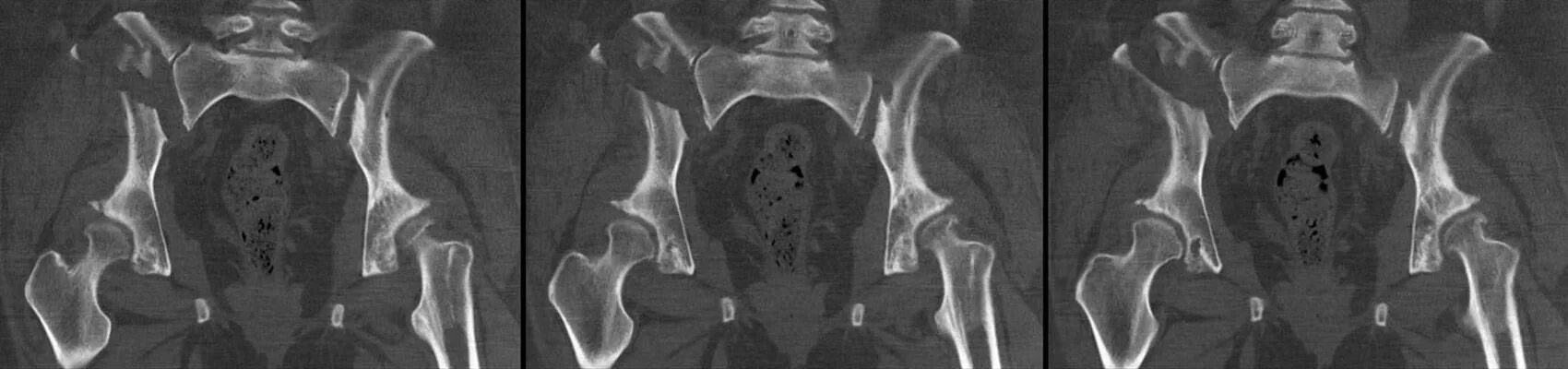 Кт подвздошной кости. Перелом подвздошной кости кт. Кт крестцово-подвздошных сочленений. Перелом костей таза кт. Остеома костей таза кт.